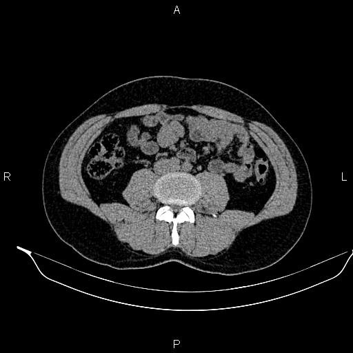 File:Adrenal myelolipoma (Radiopaedia 87794-104246 Axial non-contrast 61).jpg