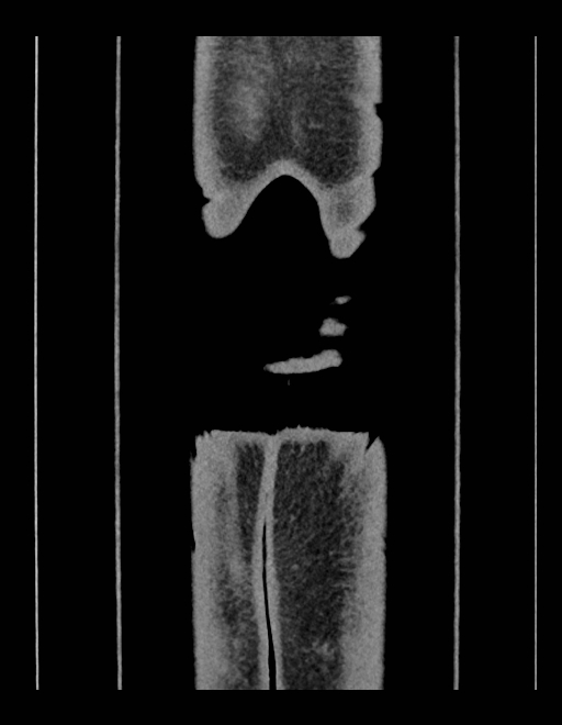 Adrenal myelolipoma - bilateral (Radiopaedia 74805-85810 Coronal C+ portal venous phase 25).jpg