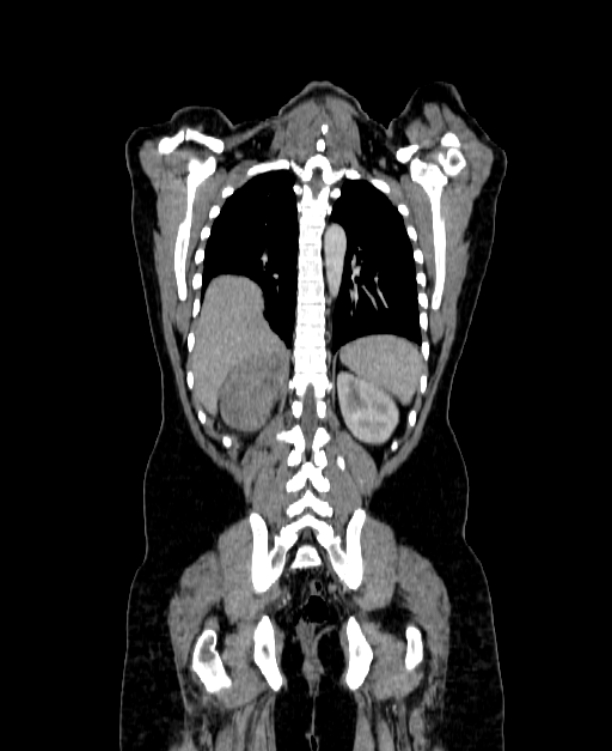 Adrenocortical carcinoma (Radiopaedia 80134-93438 Coronal C+ portal venous phase 124).jpg