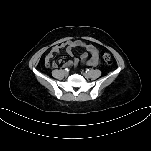 File:Adrenocortical carcinoma (Radiopaedia 87281-103569 Axial C+ arterial phase 62).jpg