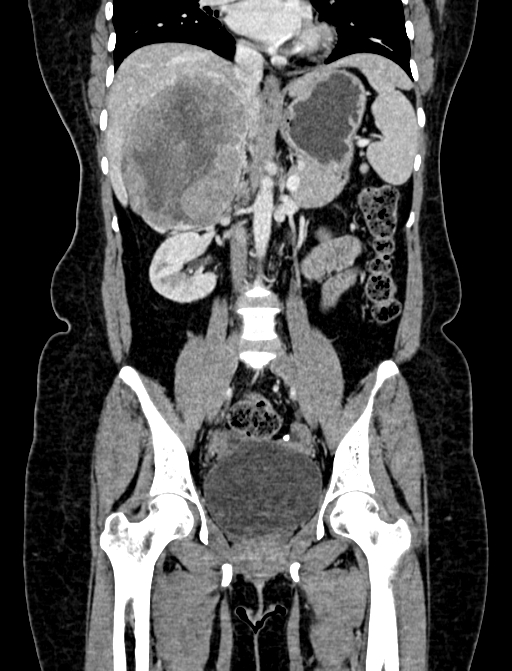 Adrenocortical carcinoma (Radiopaedia 87281-103569 Coronal C+ portal venous phase 54).jpg