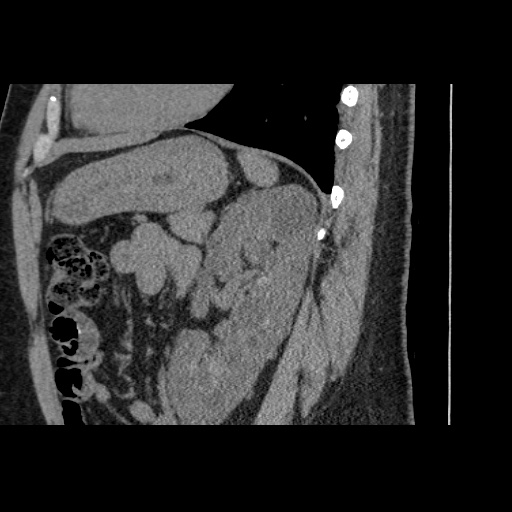 Adult polycystic kidney disease (Radiopaedia 59075-66368 Sagittal non-contrast 62).jpg