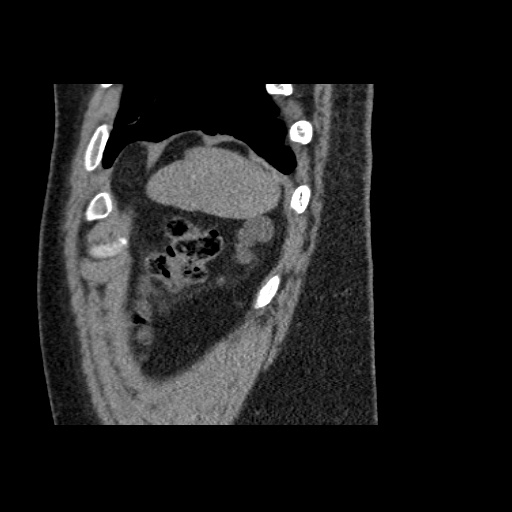 Adult polycystic kidney disease (Radiopaedia 59075-66368 Sagittal non-contrast 86).jpg