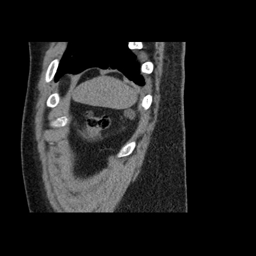 Adult polycystic kidney disease (Radiopaedia 59075-66368 Sagittal non-contrast 87).jpg