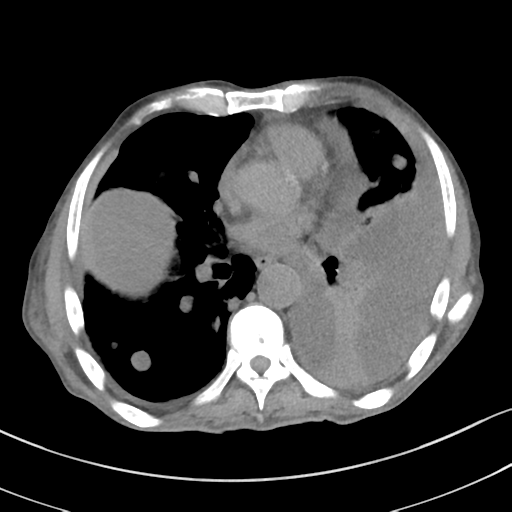 Advanced metastatic lung cancer (Radiopaedia 48910-53954 Axial non-contrast 37).png