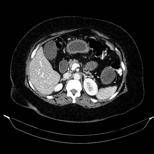 Afferent loop syndrome - secondary to incarcerated trocar site hernia (Radiopaedia 82959-97305 Axial C+ portal venous phase 78).jpg