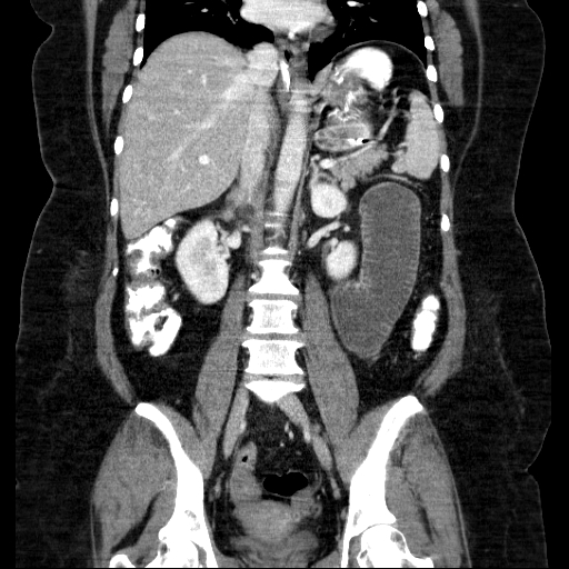File:Afferent loop syndrome - secondary to incarcerated trocar site hernia (Radiopaedia 82959-97305 Coronal C+ portal venous phase 92).jpg