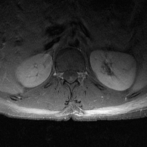 File:Aggressive vertebral hemangioma (Radiopaedia 39937-42404 Axial T1 C+ fat sat 3).png
