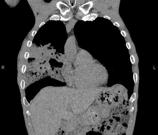 File:Air bronchogram in pneumonia (Radiopaedia 85719-101512 Coronal non-contrast 16).jpg