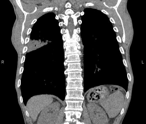Air bronchogram in pneumonia (Radiopaedia 85719-101512 Coronal non-contrast 45).jpg