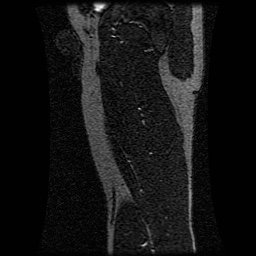 Alveolar soft part sarcoma (Radiopaedia 64501-73678 D 38).jpg