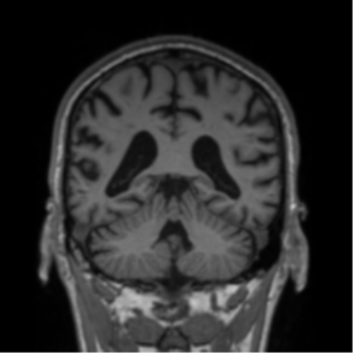 Alzheimer's disease- with Gerstmann syndrome and dressing apraxia (Radiopaedia 54882-61150 Coronal T1 32).png