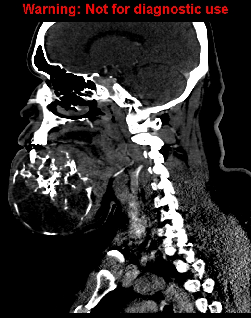 Ameloblastoma (Radiopaedia 33126-34164 F 32).jpg