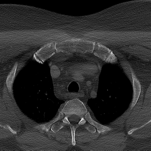 Ameloblastoma (Radiopaedia 38520-40623 Axial bone window 82).png