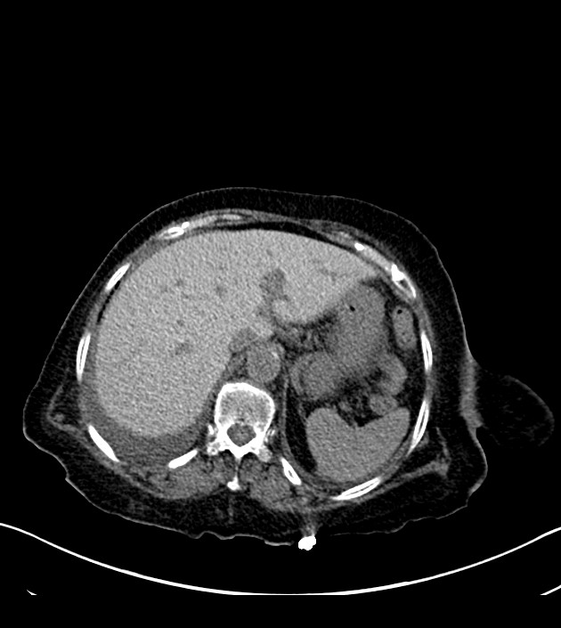 Amiodarone deposition in the liver (Radiopaedia 77587-89780 Axial non-contrast 76).jpg