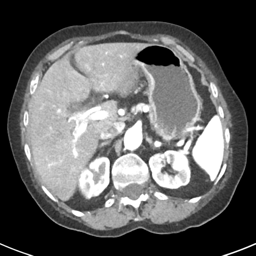 Ampullary adenocarcinoma (Radiopaedia 34013-35237 B 23).png