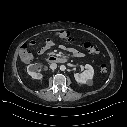 Ampullary adenocarcinoma (Radiopaedia 59373-66737 A 74).jpg
