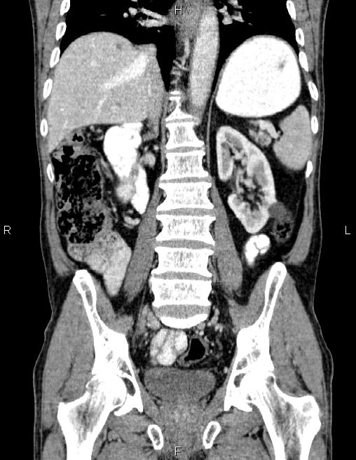 Ampullary adenocarcinoma (Radiopaedia 86093-102032 C 42).jpg