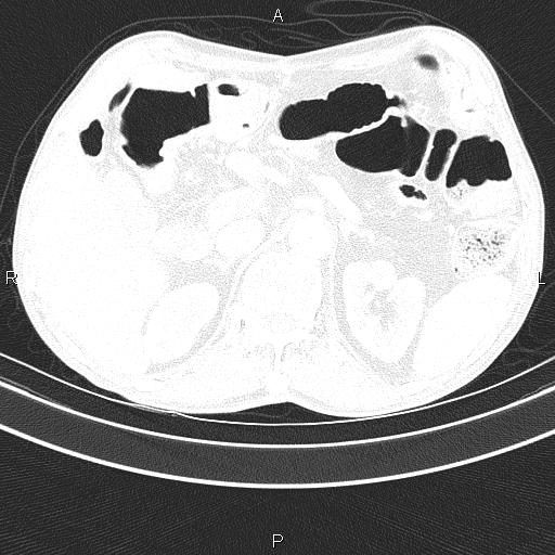 Ampullary adenocarcinoma (Radiopaedia 86093-102033 Axial lung window 59).jpg