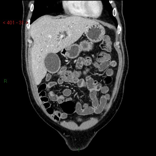 Ampullary carcinoma (Radiopaedia 56396-63056 E 30).jpg