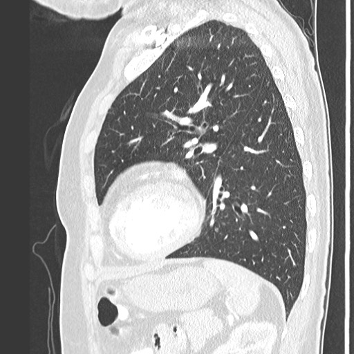 Amyloidosis - bronchial and diffuse nodular pulmonary involvement (Radiopaedia 60156-67745 Sagittal lung window 64).jpg