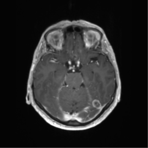 File:Anaplastic astrocytoma (Radiopaedia 86943-103160 Axial T1 C+ 8).png