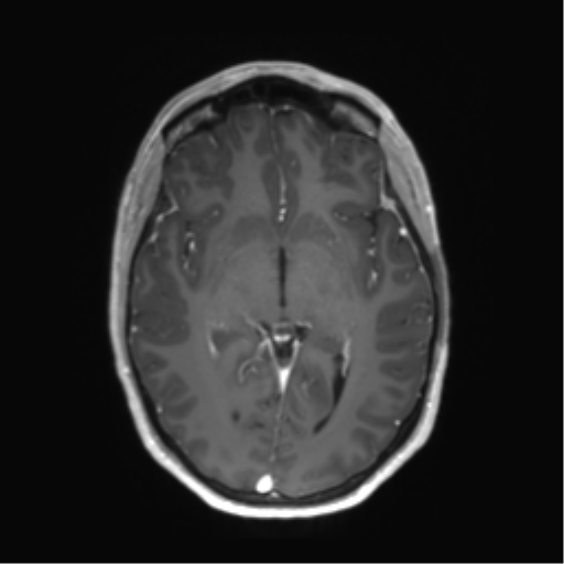 File:Anaplastic astrocytoma IDH mutant (Radiopaedia 50046-55341 Axial T1 C+ 24).png