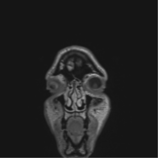 Anaplastic astrocytoma IDH mutant (Radiopaedia 50046-55341 Coronal FLAIR 58).png