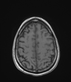 Anaplastic astrocytoma IDH wild-type (Radiopaedia 49984-55273 Axial T1 45).png