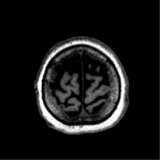 Anaplastic astrocytoma IDH wild-type (pseudoprogression) (Radiopaedia 42209-45277 Axial T1 120).png