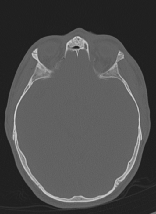 Anaplastic oligodendroglioma with skull fracture (Radiopaedia 74831-85846 Axial bone window 42).png