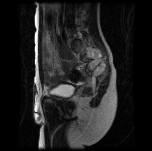File:Aneurysmal bone cyst - sacrum (Radiopaedia 65190-74196 Sagittal T2 13).jpg
