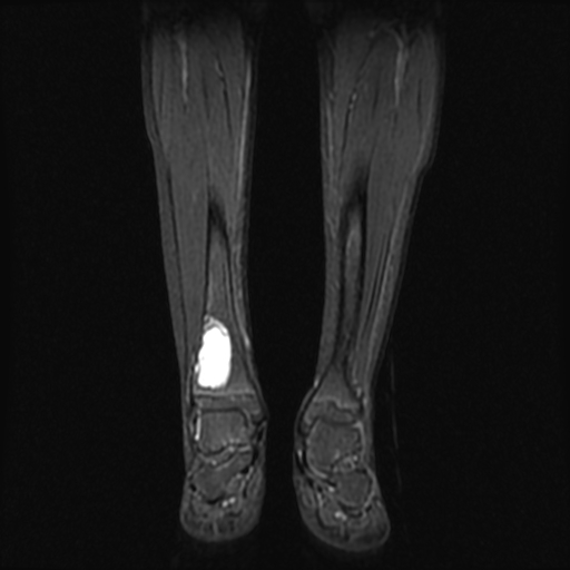 File:Aneurysmal bone cyst - tibia (Radiopaedia 22343-22367 Coronal STIR 8).jpg