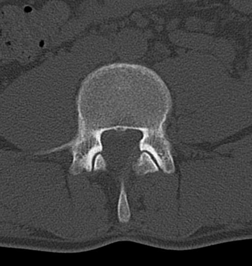 Aneurysmal bone cyst T11 (Radiopaedia 29294-29721 Axial bone window 97).jpg