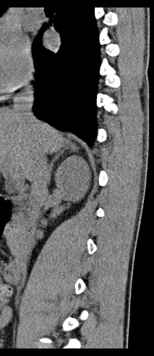 Aneurysmal bone cyst T11 (Radiopaedia 29294-29721 E 60).jpg