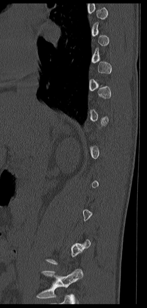 Aneurysmal bone cyst T11 (Radiopaedia 29294-29721 Sagittal bone window 57).jpg