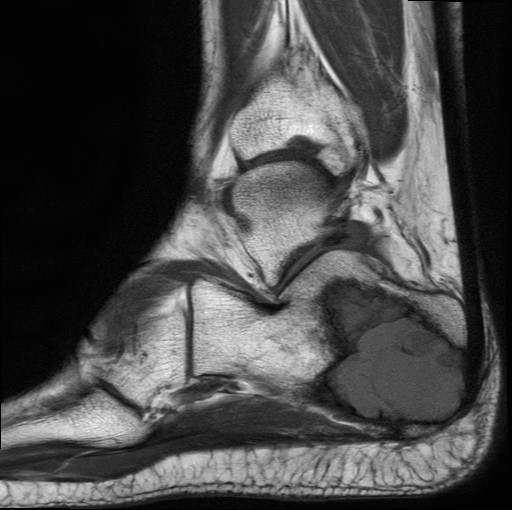 File:Aneurysmal bone cyst of the calcaneus (Radiopaedia 60669-68420 Sagittal T1 6).jpg