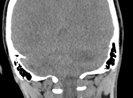 Angular dermoid cyst (Radiopaedia 88967-105790 Coronal non-contrast 94).jpg