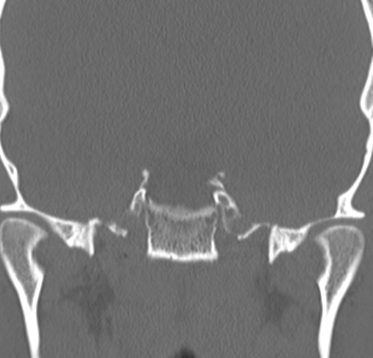 Angular epidermoid cyst (Radiopaedia 46908-51439 Coronal bone window 55).png