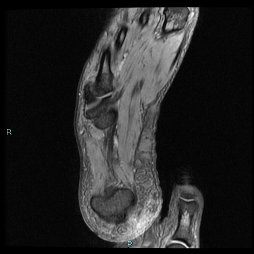 Ankle ganglion cyst (Radiopaedia 62809-71162 Axial Gradient Echo 5).jpg