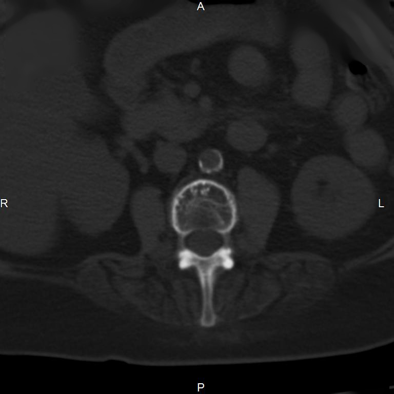 Ankylosing spondylitis (Radiopaedia 8748-9556 Axial bone window 28).jpg