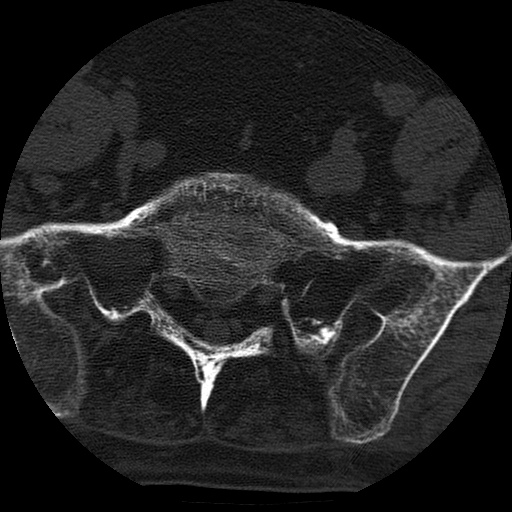 File:Ankylosing spondylitis complicated by fracture-dislocation (Radiopaedia 33583-34674 Axial non-contrast 155).jpg