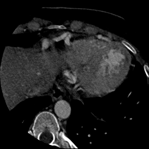 Anomalous left coronary artery from the pulmonary artery (ALCAPA) (Radiopaedia 40884-43586 A 75).jpg