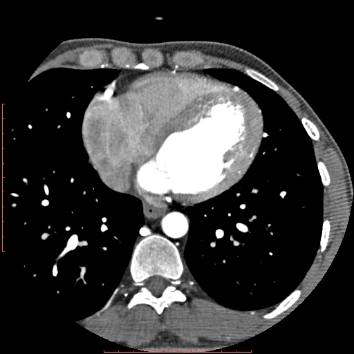 File:Anomalous left coronary artery from the pulmonary artery (ALCAPA) (Radiopaedia 70148-80181 A 237).jpg