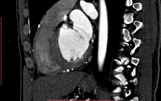 File:Anomalous left coronary artery from the pulmonary artery (ALCAPA) (Radiopaedia 70148-80181 C 147).jpg