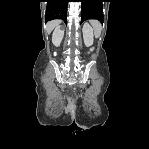 Anorectal carcinoma (Radiopaedia 44413-48064 B 70).jpg