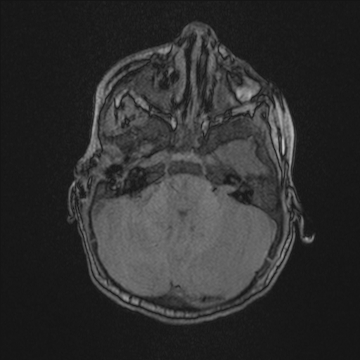Anoxic brain injury (Radiopaedia 79165-92139 Axial MRA 54).jpg