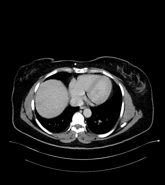 Anterior abdominal wall CSF pseudocyst (CSFoma) (Radiopaedia 79453-92571 A 11).jpg