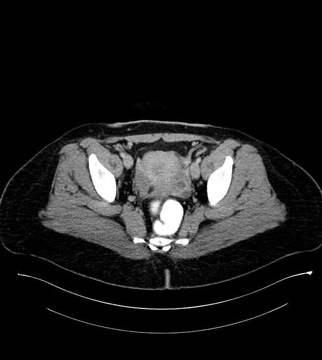 Anterior abdominal wall CSF pseudocyst (CSFoma) (Radiopaedia 79453-92571 A 80).jpg