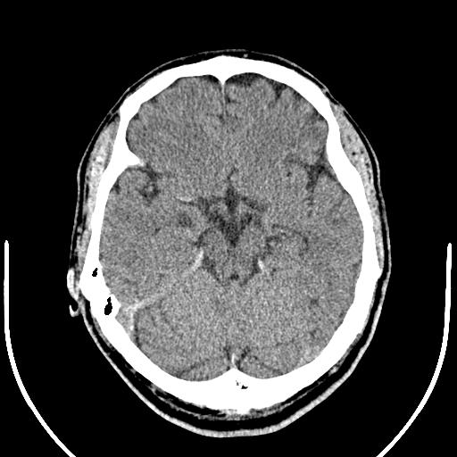 Anterior choroidal artery infarct (Radiopaedia 55106-61480 Axial non-contrast 20).jpg